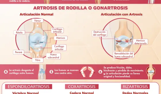 IMPACTO DE LA ARTROSIS EN LAS ARTICULACIONES