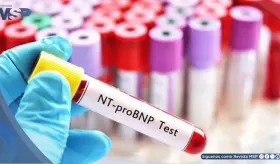 NT-proBNP podr&iacute;a ayudar a predecir riesgo de un nuevo evento cardiovascular tras un infarto