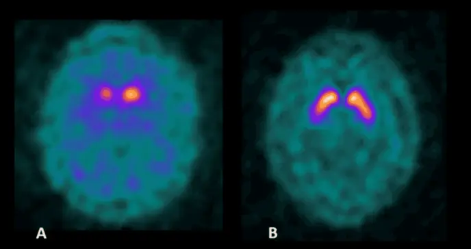 Hombre de 52 años con esquizofrenia tratado con antipsicóticos desarrolla parkinsonismo idiopático 