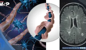 Identifican biomarcadores en sangre y l&iacute;quido cefalorraqu&iacute;deo que predicen la esclerosis m&uacute;ltiple