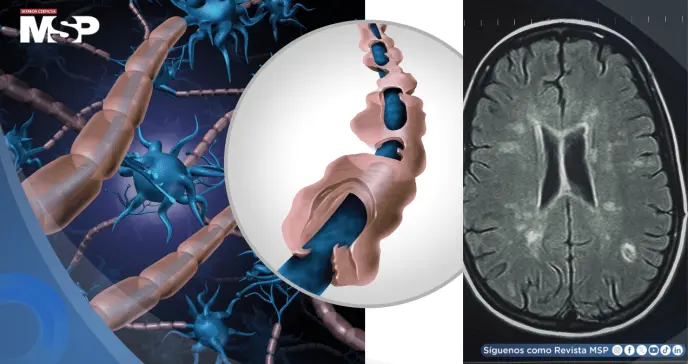 Identifican biomarcadores en sangre y líquido cefalorraquídeo que predicen la esclerosis múltiple