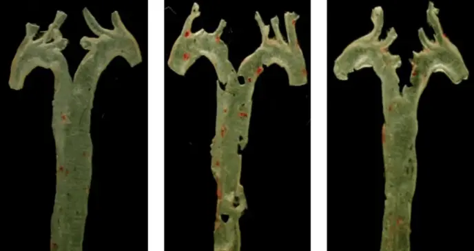 Revolución en la medicina: una molécula producida por bacterias del intestino causa la aterosclerosis Revolución en la medicina: una molécula producida por bacterias del intestino causa la aterosclerosis