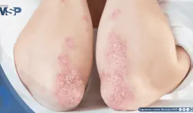 Consenso sobre tratamiento de la psoriasis en placas: Definen la remisión