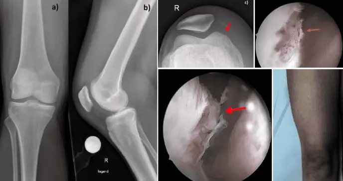 Mujer desarrolla artritis séptica con infección articular por Enterococcus faecium tras picotazo de gallo