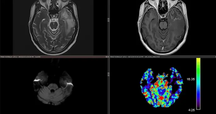 Necrosis del lóbulo temporal como complicación tardía de radioterapia en carcinoma nasofaríngeo