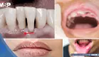Xerostomía, gingivitis y pérdida dental: posibles complicaciones  asociadas al uso de antipsicóticos