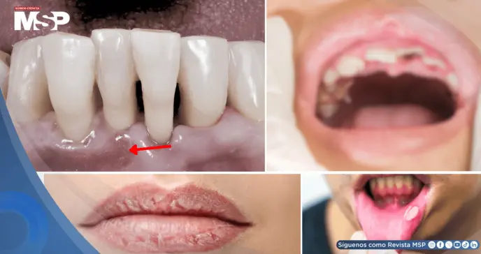 Xerostomía, gingivitis y pérdida dental: posibles complicaciones  asociadas al uso de antipsicóticos