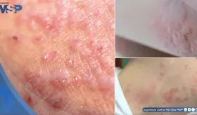 Dermatitis y urticaria solar: por qu&eacute; tu piel reacciona como si le tuvieras &acute;alergia&acute; al sol