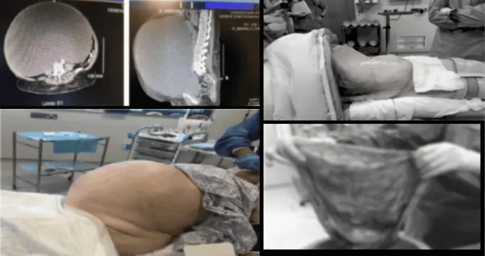 Hallan quiste ovárico de 54 cm en mujer de 71 años con histerectomía previa