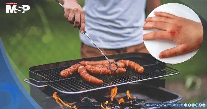 El 75% de las quemaduras en barbacoas se deben al uso incorrecto de líquidos inflamables, estudio El 75% de las quemaduras en barbacoas se deben al uso incorrecto de líquidos inflamables, estudio