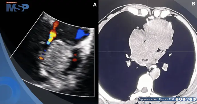 Detectan raro tumor cardíaco maligno en paciente con síntomas comunes de cardiomiopatía