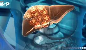 El 60% de los casos de cáncer de hígado se pueden prevenir, según estudio
