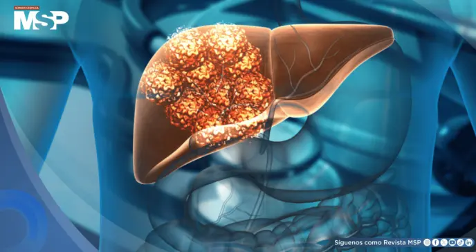 El 60% de los casos de cáncer de hígado se pueden prevenir, según estudio El 60% de los casos de cáncer de hígado se pueden prevenir, según estudio