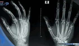 ¿Dolor o rigidez en las manos? Podría ser artrosis y detectarla a tiempo mejoraría el tratamiento