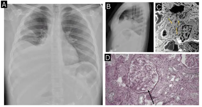 Dolor abdominal y fluctuación del ciclo menstrual como manifestaciones de lupus eritematoso sistémico 