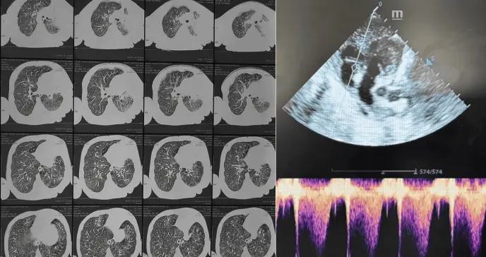 Hipertensión pulmonar en lactante no vacunada con leucocitosis grave por tos ferina severa Hipertensión pulmonar en lactante no vacunada con leucocitosis grave por tos ferina severa