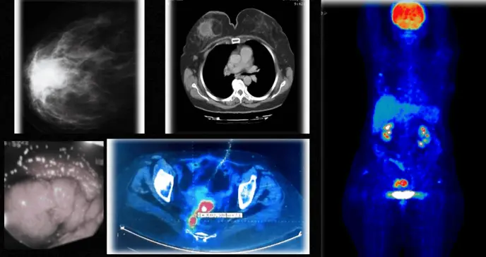 Detectan cáncer de mama y cáncer rectal simultáneos con reactivación de hepatitis B tras quimioterapia Detectan cáncer de mama y cáncer rectal simultáneos con reactivación de hepatitis B tras quimioterapia