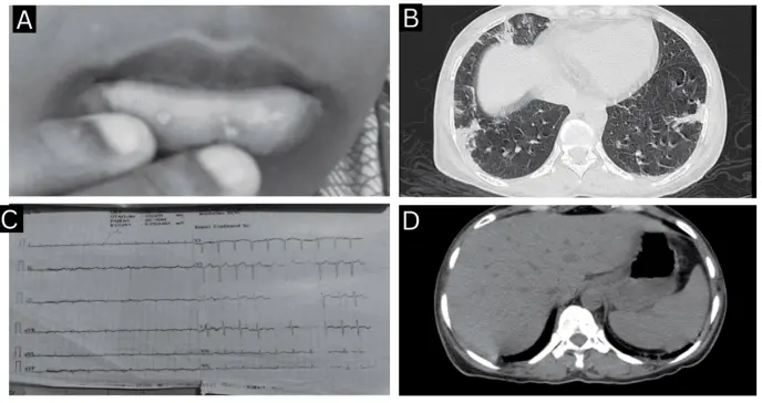 Hemorragia gastrointestinal superior y neumonía como manifestación inicial de lupus eritematoso sistémico Hemorragia gastrointestinal superior y neumonía como manifestación inicial de lupus eritematoso sistémico