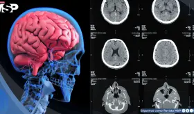 Identifican biomarcador que predice respuesta a tratamientos antipsic&oacute;ticos en esquizofrenia