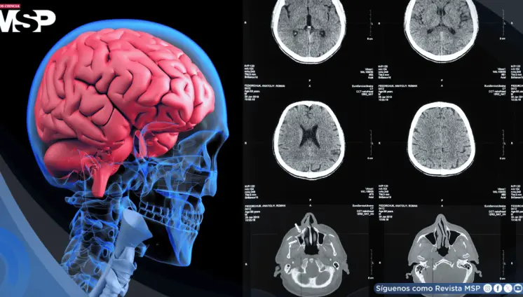 Identifican biomarcador que predice respuesta a tratamientos antipsicóticos en esquizofrenia Identifican biomarcador que predice respuesta a tratamientos antipsicóticos en esquizofrenia