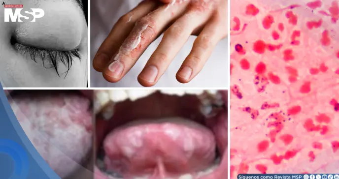 Gonorrea: qué es, síntomas, tratamiento, prevención y cómo evitar sus daños permanentes  Gonorrea: qué es, síntomas, tratamiento, prevención y cómo evitar sus daños permanentes