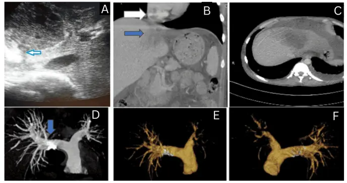 Absceso hepático amébico rompe la vena cava inferior y causa embolia pulmonar masiva en paciente Absceso hepático amébico rompe la vena cava inferior y causa embolia pulmonar masiva en paciente
