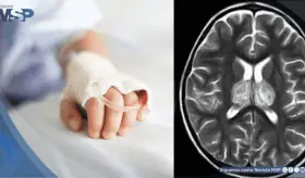Alertan sobre aumento de encefalopat&iacute;a necrosante infantil asociada a la gripe