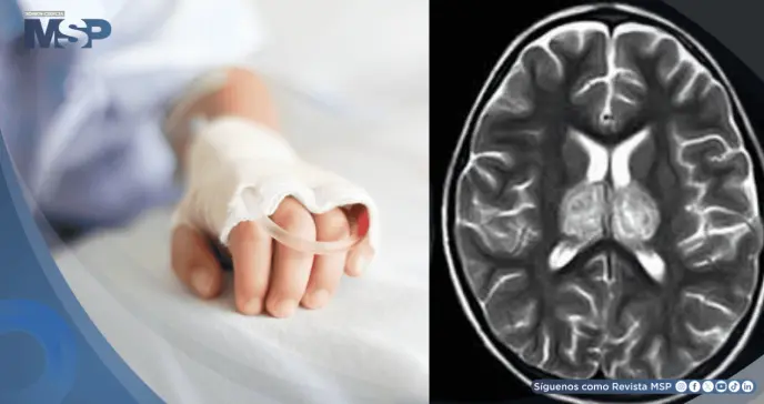 Alertan sobre aumento de encefalopatía necrosante infantil asociada a la gripe