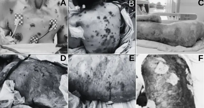 Pénfigo vulgar refractario a corticoides tratado con éxito con rituximab sin dermatología hospitalaria Pénfigo vulgar refractario a corticoides tratado con éxito con rituximab sin dermatología hospitalaria