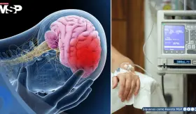 Quimioterapia se asocia a atrofia cerebral en pacientes con cáncer de mama