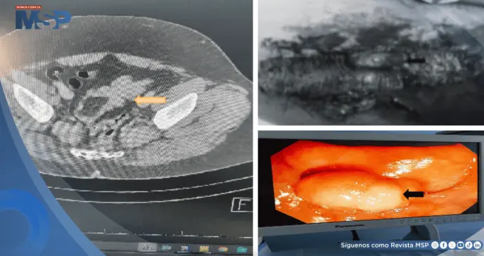 Dolor abdominal persistente terminó revelando un lipoma gigante en el colon sigmoide