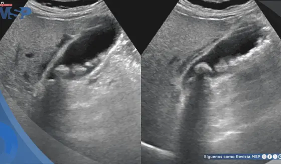 Relación entre el funcionamiento de la vesícula y el dolor de espalda o cervical