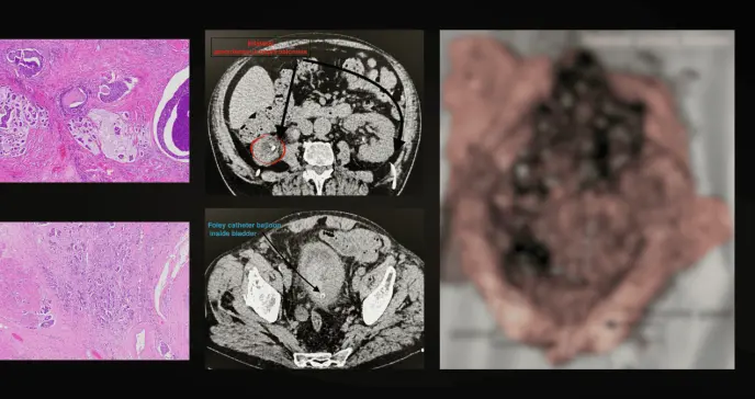 Paciente de 89 años desarrolla peritonitis química por filtración urinaria secundaria a cáncer vesical Paciente de 89 años desarrolla peritonitis química por filtración urinaria secundaria a cáncer vesical