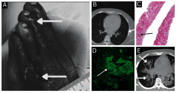 Presentación atípica de granulomatosis con poliangitis: úlceras y cutáneas como manifestación inicial Presentación atípica de granulomatosis con poliangitis: úlceras y cutáneas como manifestación inicial