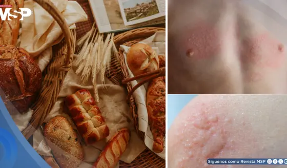 Nueva guía sobre la alergia al pan: causas, síntomas, diagnóstico y manejo
