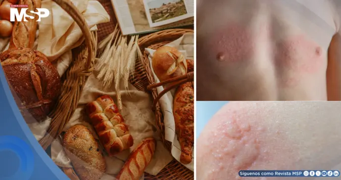 Nueva guía sobre la alergia al pan: causas, síntomas, diagnóstico y manejo