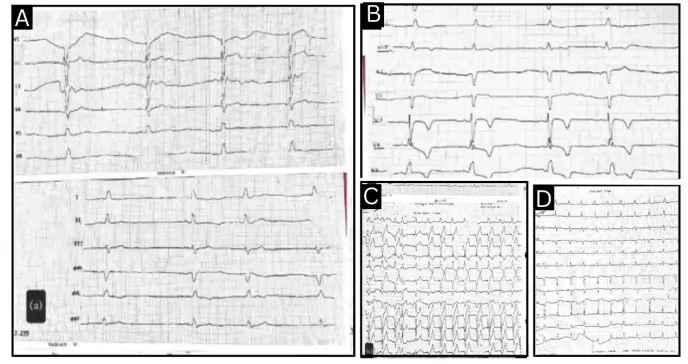 Paciente sufre paro cardíaco por intoxicación crónica con litio tras 25 años sin supervisión médica
