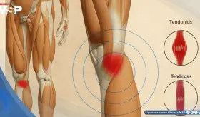 Tendinitis vs. tendinosis: diferencias, síntomas y tratamiento efectivo