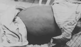 Pancreatitis aguda grave en un paciente fumador