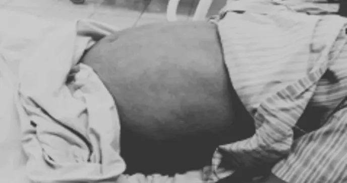 Pancreatitis aguda grave en un paciente fumador