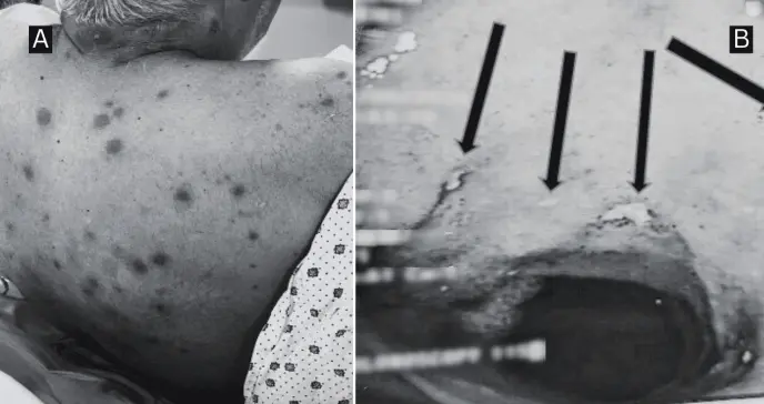 Síndrome de Sweet febril con erupción cutánea como manifestación inicial de enfermedad de Crohn ileocecal