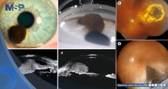 ¿Te cuidas la vista? El melanoma uveal puede no dar señales antes de producir metástasis hepáticas
