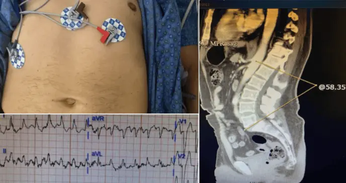 Taquicardia, dolor abdominal y torácico como presentación del síndrome de la persona rígida en diabético