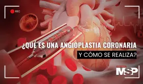 &iquest;Qu&eacute; es una angioplastia coronaria y c&oacute;mo se realiza?