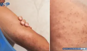 &iquest;Piel &aacute;spera y bultos en brazos o muslos? Descubre qu&eacute; es la queratosis pilaris: causas, y tratamiento