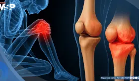 La condrocalcinosis podr&iacute;a aumentar 75% el riesgo de desarrollar osteoartritis de rodilla, seg&uacute;n estudio