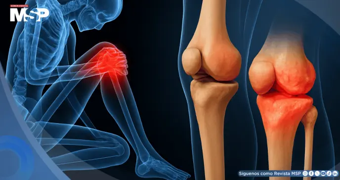 La condrocalcinosis podría aumentar 75% el riesgo de desarrollar osteoartritis de rodilla, según estudio