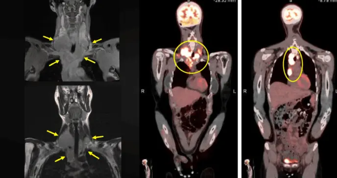 Masa cervical, fiebre y pérdida de peso como presentación de un linfoma de Hodgkin con carga viral