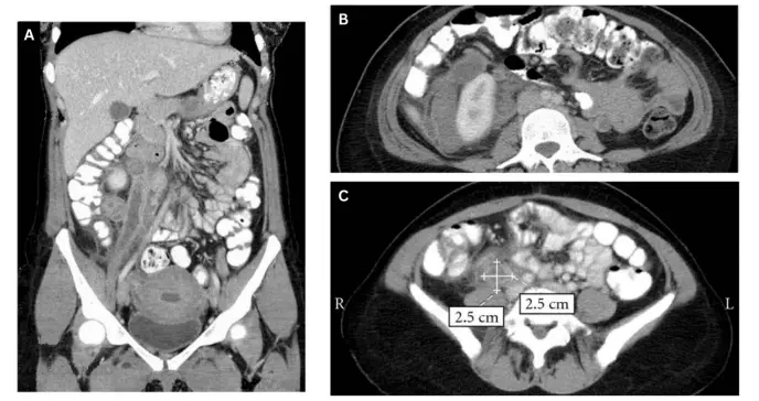 Dolor pélvico y masa abdominal palpable como presentación de trombosis venosa ovárica tras el parto