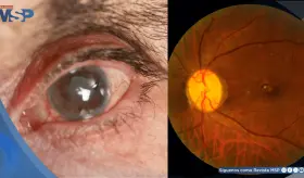 Dispositivo permite drenaje efectivo del líquido ocular y promete mejores resultados en el glaucoma